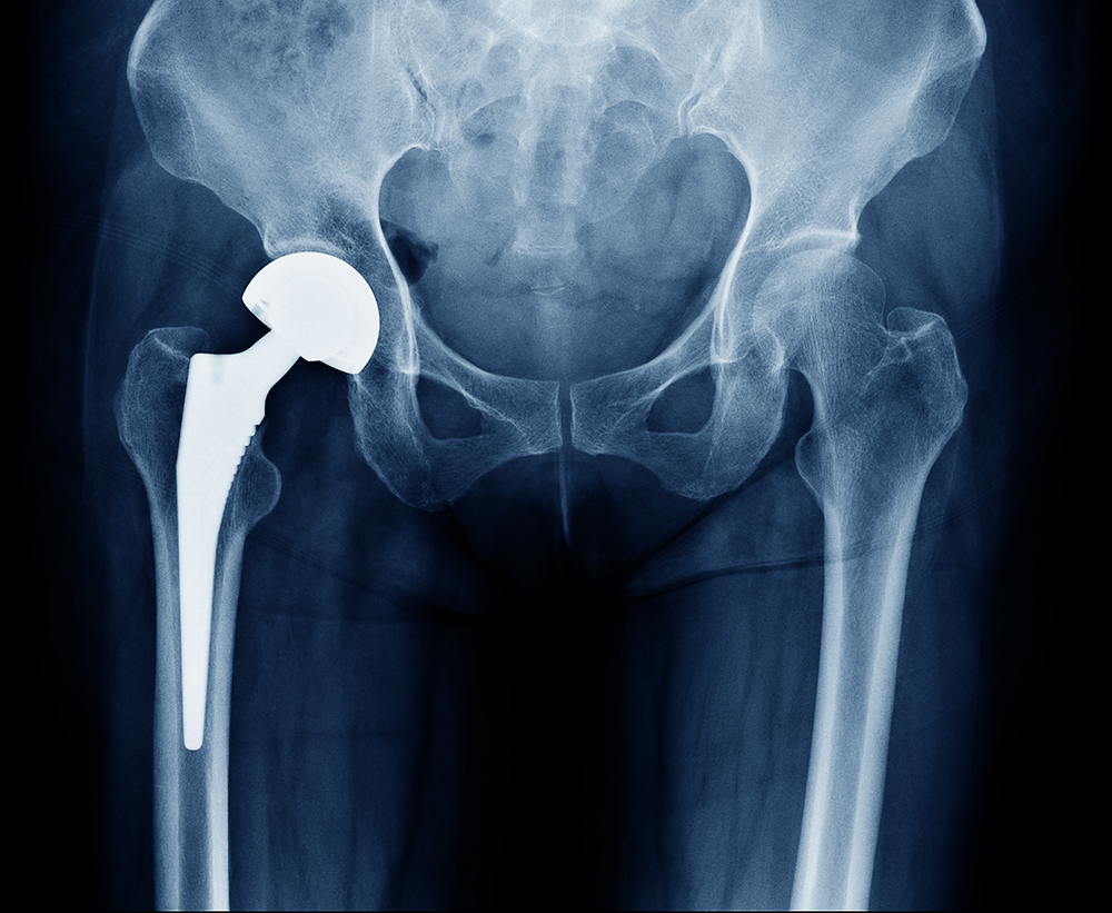 X-ray showing a hip replacement